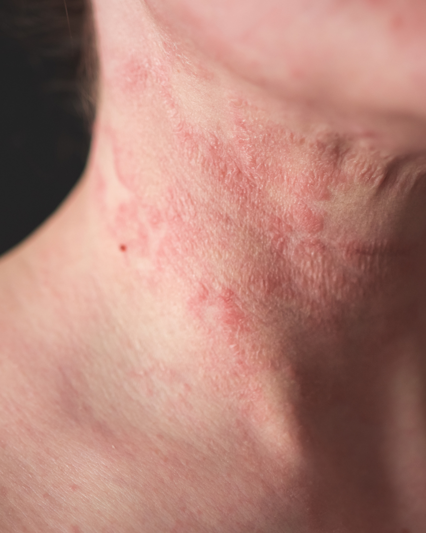 Consejos para tratar las 6 afecciones cutaneas mas comunes en invierno uai