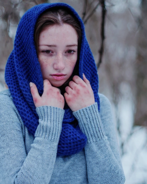 Como diferenciar y tratar las eczemas ocasionadas por el frio uai